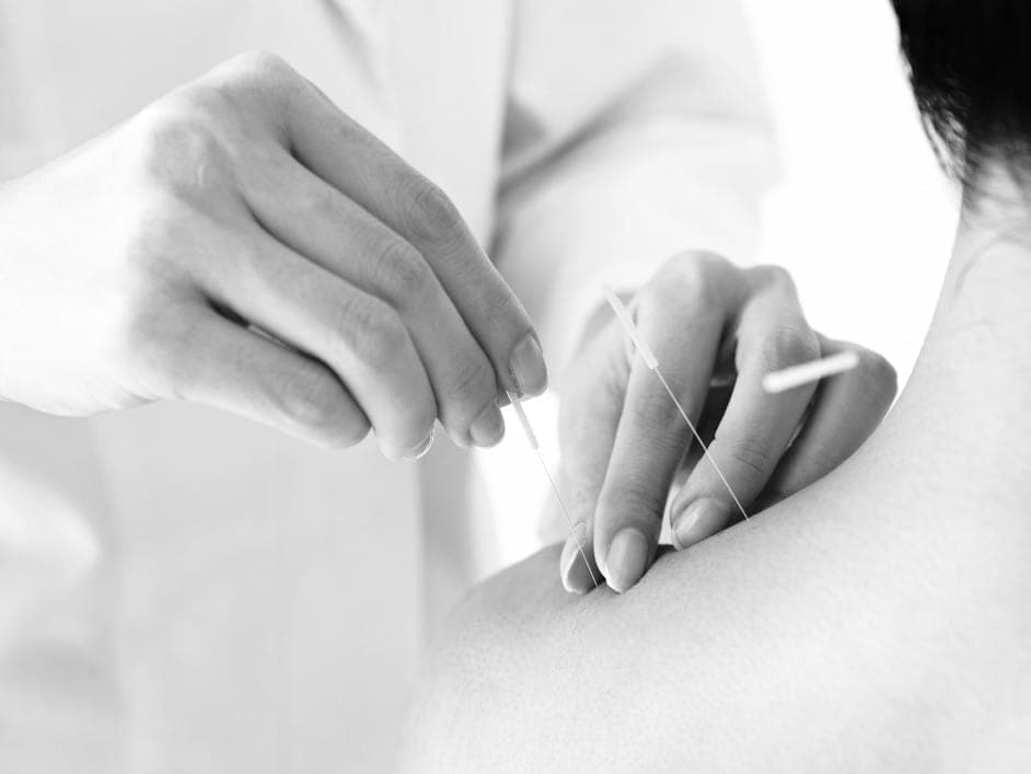 Black and white close-up of hands inserting acupuncture needles into a patient's shoulder.