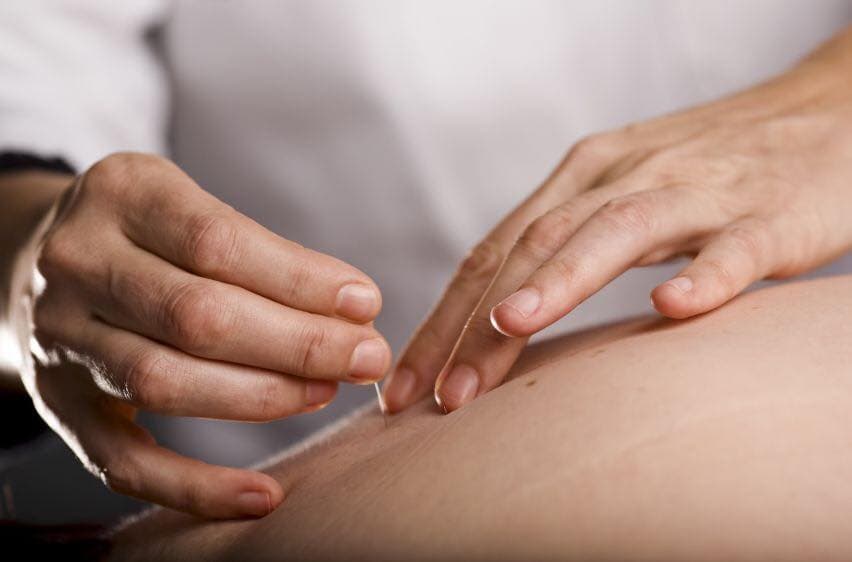 Acupuncturist's hands inserting fine needles into a patient's skin during treatment.